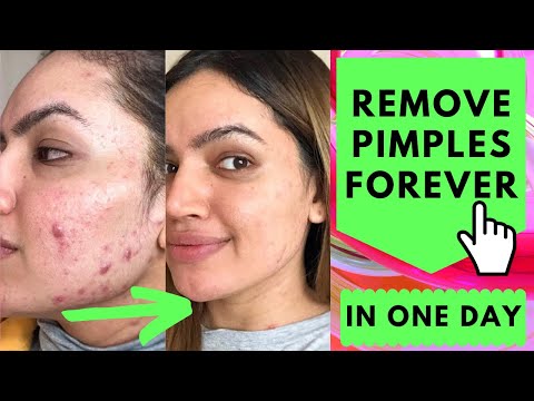 Remove Pimples Forever In 1 Day | Best Acne Treatment | Home Remedy For Pimples
