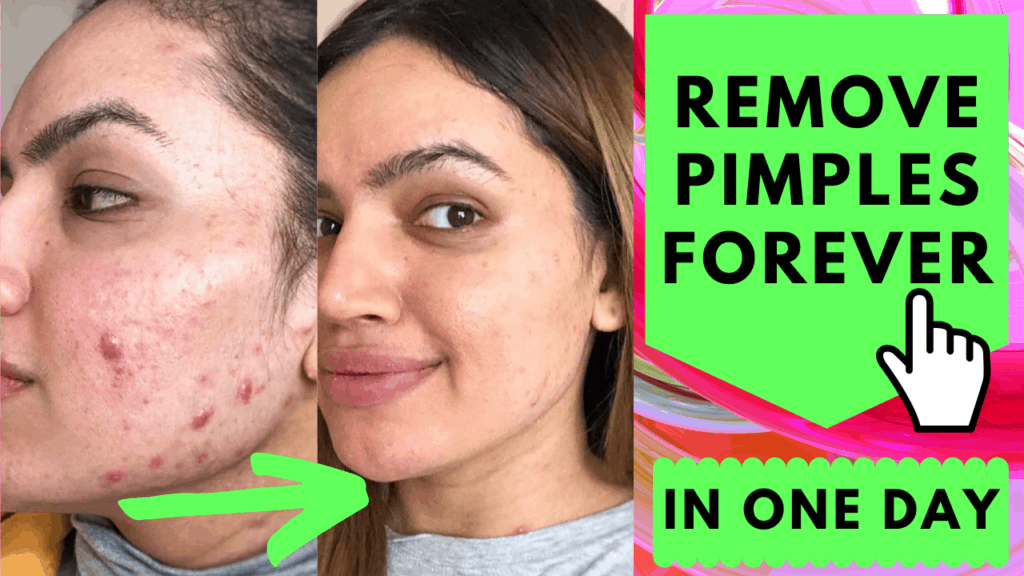 how to remove pimples